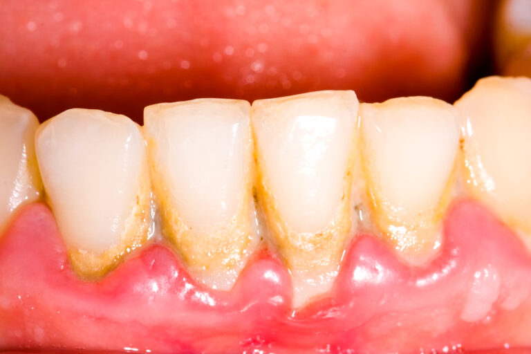Diseases in the gums, what are they?
