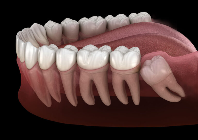 Teeth included, retained or impacted and their treatment